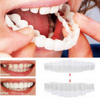 Snap-On Cosmetic Veneers, Upper & Lower