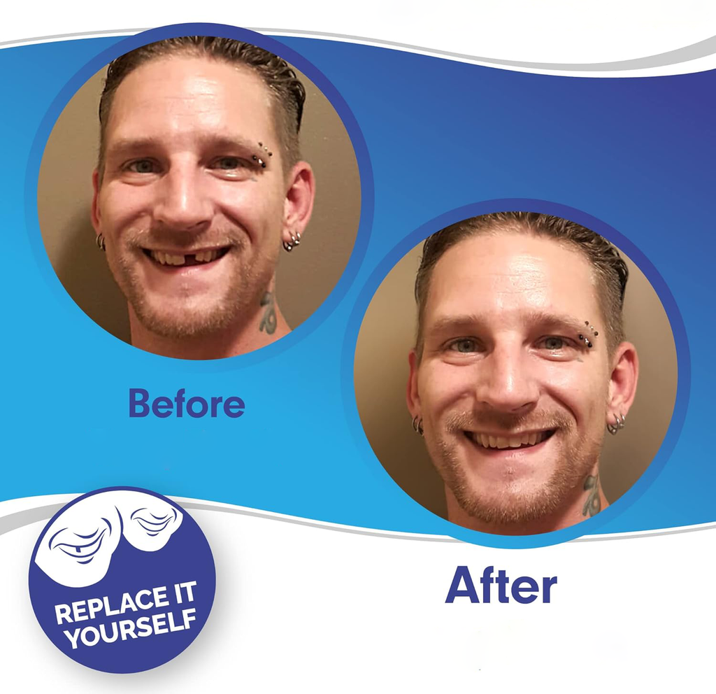 Snap-On Cosmetic Veneers, Upper & Lower