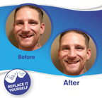 Snap-On Cosmetic Veneers, Upper & Lower