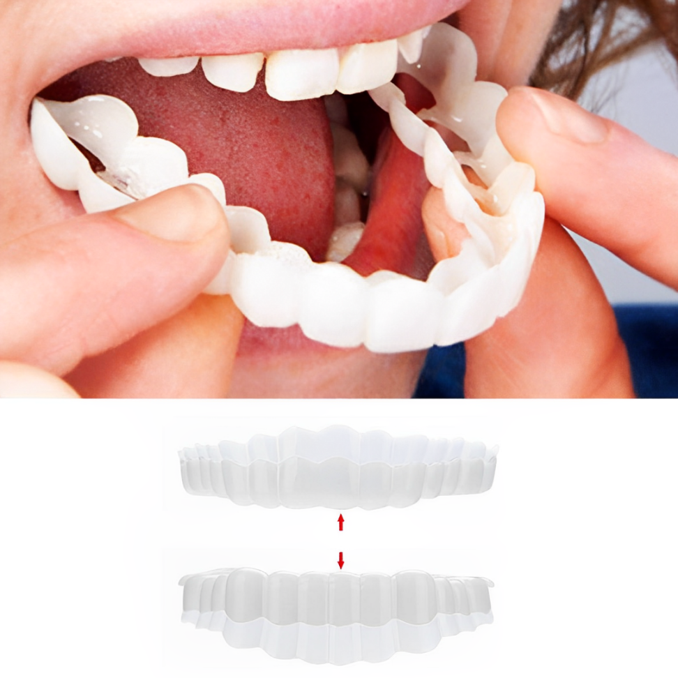 Snap-On Cosmetic Veneers, Upper & Lower
