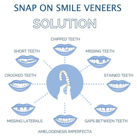 Snap-On Cosmetic Veneers, Upper & Lower